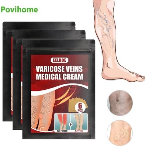 12Pcs Varicose Veins Treatment Patch Phlebitis Vasculitis Thigh Spider Removal Blood Vessel Anti Swelling Pain Relief Plaster