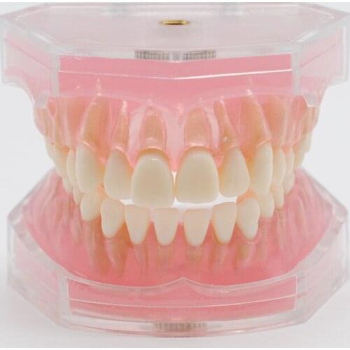 Dentistry Lab Teeth Study Model Overdenture Inferior 4 Implant Demo Model
