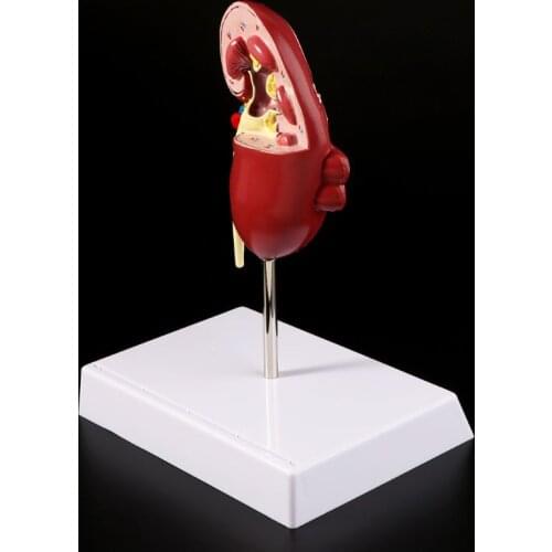 Life Size Human Kidney Diseased Model Anatomical Anatomy Diseased Pathological Stone Organ Teaching Supplies M5TE