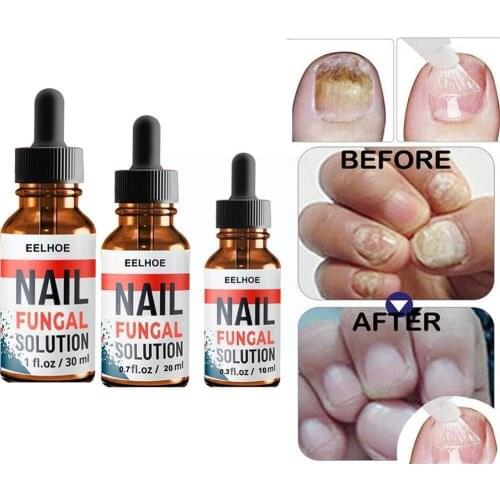 30ml Fungal Nail Treatment Pen To Remove Onychomycosis Nail Anti Liquid Care Fungal Healthy Paronychia Polish Tool C7V7