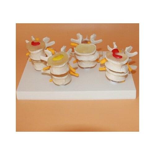 Free shipping Human skeleton model lumbar disc disease model spine model lumbar bone lesions Model