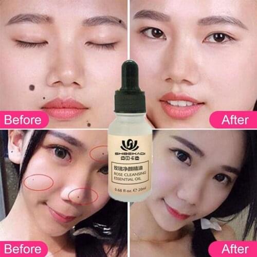 Non-Trace Verwijderen Mollen Potion Comedondrukker Repair Moles Fluid Face Remove Remover Toe Treatment Foot Hand Potion N7C6