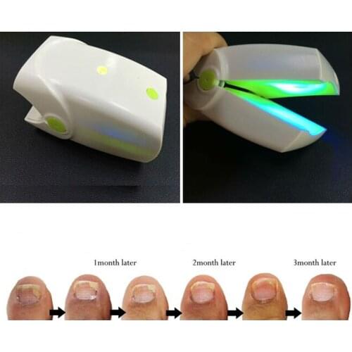 Toenails Fungus Onychomycosis Treatment Anti Nail Fungal Infection Low Level Laser Light Therapy Device LLLT No Pain