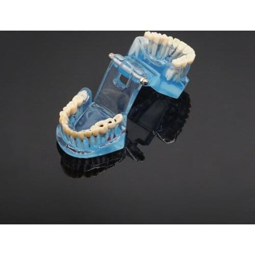 Dental Clinic Study Tooth Model Adult Pathological Teaching Teeth Model Caries