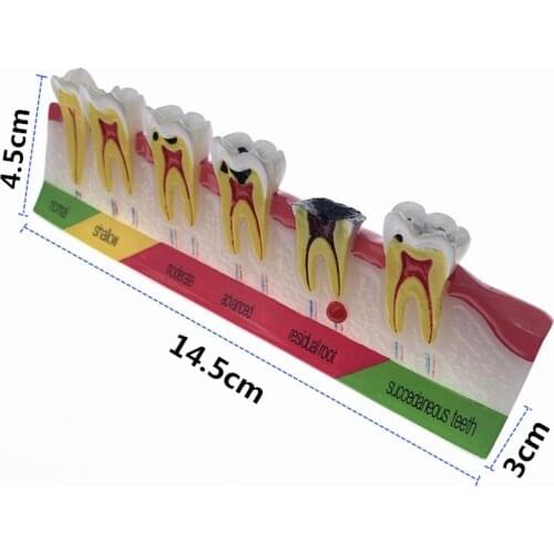 Teach Study Dental teeth caries Evolution decayed tooth Analysis Model