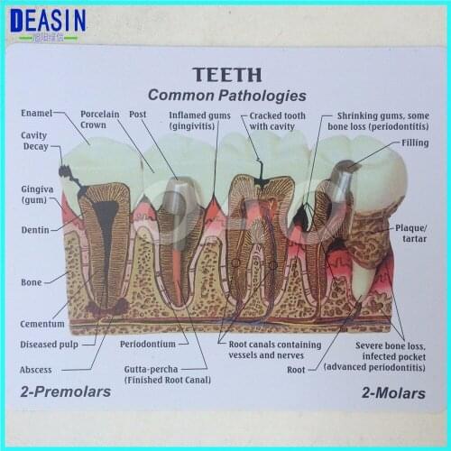 High Quality Dentistry Rich Details Teaching Aids Caries Tooth Model Dentist Patient Communication Anatomy Model Equipment