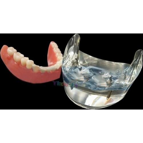 1Pc High QualityDental 4 Implant Teeth Study Model Overdenture Inferior Demo Model