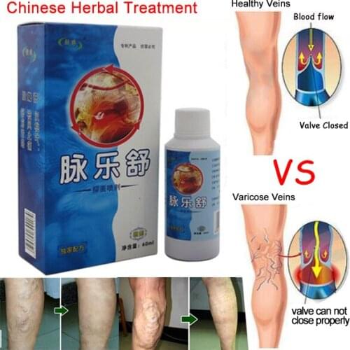 3pieces per lot Vasculitis Spray Varicose Veins Treatment Spray On Leg Acid Bilges Itching Earthworm Lumps Bad Leg Cure Natural