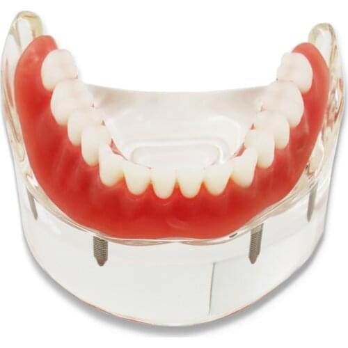 Dental Model Overdenture Inferior Precision Implant Demo Removable Interior Mandibular Lower Teeth Model Mandibular with Implant