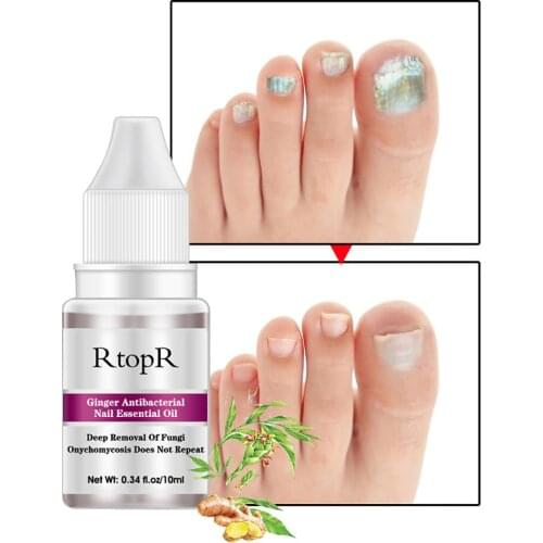 Medicine Nail Treatment Serum Nail Foot Nail Fungus Removal Gel Anti Infection Onychomycosis Nail Repair Essence Cream Feet Care