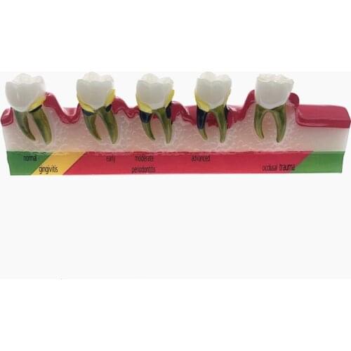 Free Shipping Dental Periodontal Disease Assort Tooth Typodont Model