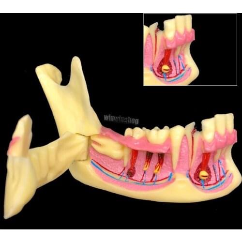 1PC Dental Mandibular Teeth Demonstration Anatomical Patient Study Teaching Model