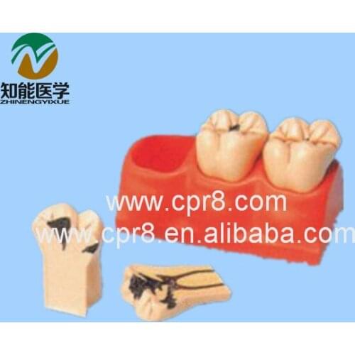 BIX - L1005 Caries Decomposition Model (Caries) MQ150