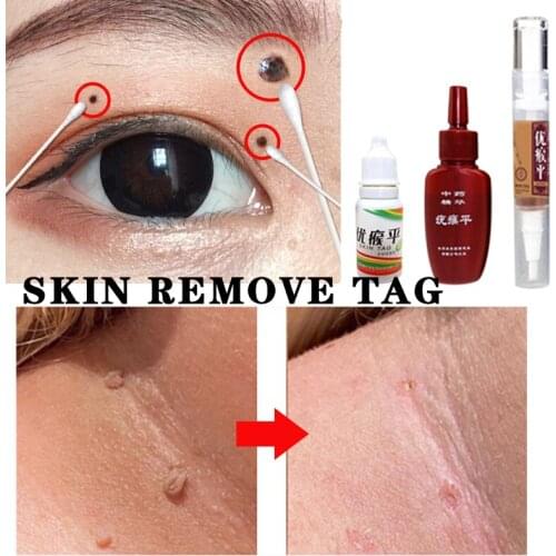 5ml Skin Tag Remover 12 hours Medical fast Removal Mole & Genital Wart Foot Corn Treatment Anti Wart Bacteriostatic hot sale