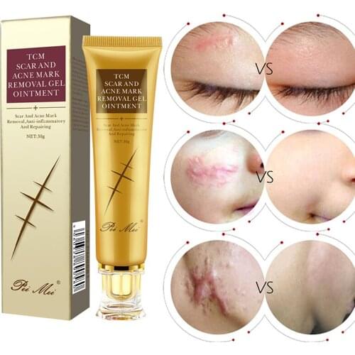 Remove Acne Smoothing Whitening Moisturizing Body Skin Care Aichun Acne Scar Removal Cream Pimples Stretch Marks Face Gel