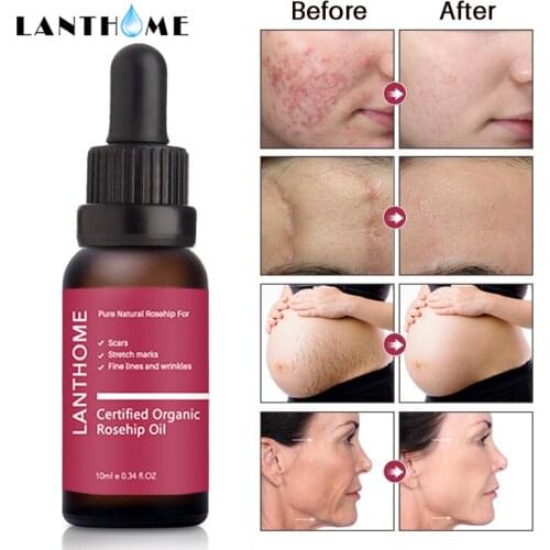 10ml Rosehip Oil Organic Moisturizer Anti Aging Essential Oil Face Skin Care Massage Heal Dry Skin Fineline Wrinkle Stretch Mark