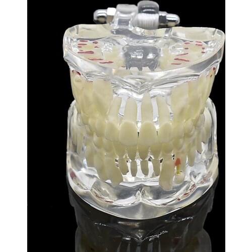Dental Children Pathological Teeth Model Dentist Orthodontic Model Oral Hygiene Demonstration Tooth Study Teaching Showing