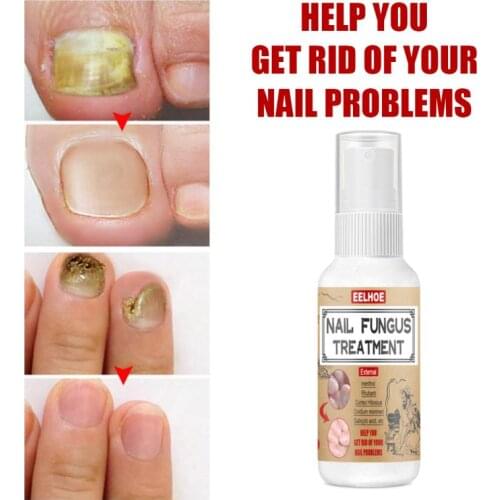 Professional Nail Fungal Cure Nail Fungus Removal Spray Nutritious Anti Paronychia Onychomycosis Fungal Nail Repair Spray TSLM1