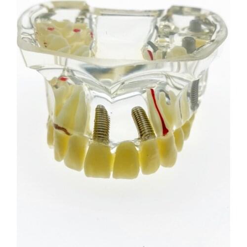 Dental Implant Upper Jaw Model With Bridge & Caries Dental Study Teach Teeth Model