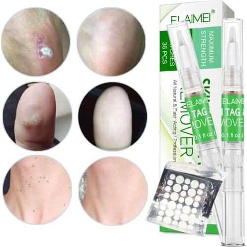 Skin Tag Remover Fast Remove All Moles Warts Spots Freckles Anti Foot Corn Removal Warts Papillomas Rapidly Removes Moles TSLM1