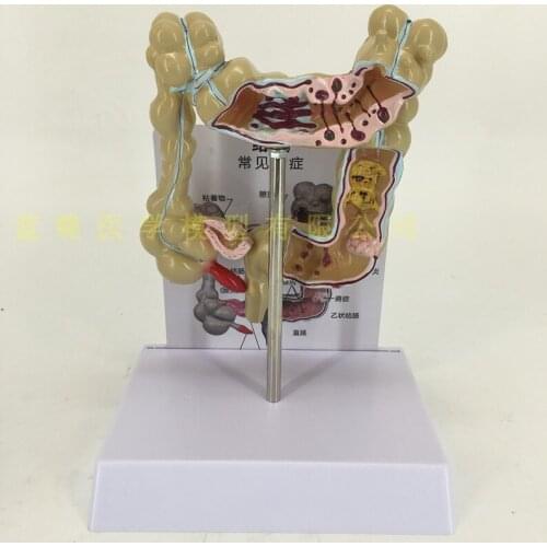 Colonic pathology large intestine olorectal lesion model intestinal disease colonic lesion