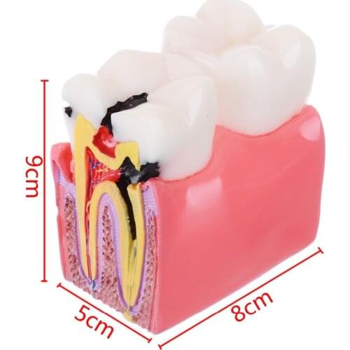 1pc 6 Times Dental Caries Comparsion Models Tooth Decay Model For Dental Study Teaching Dental Anatomy Education Teeth Model