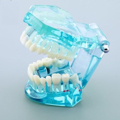Dental Disease Teeth Model With Restoration Bridge Crown Dental Model Mariland Bridge Implant and Restoration Model with Nerve