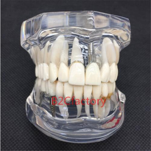 6pcs/lot Dental Implant Disease Teeth Model With Restoration Bridge Tooth