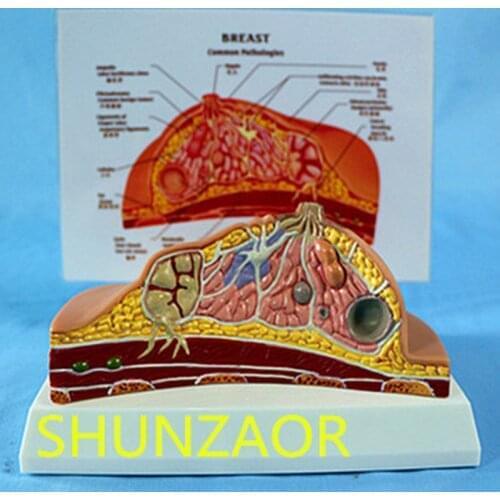 1:1 Median Section of Human Female Breast Pathology Anatomy Model Kit Table-type breast lesion model lactating breasts