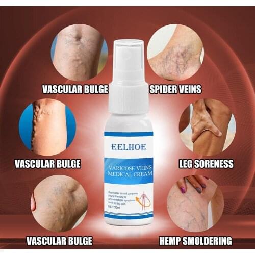 Varicose Veins Spray Vasculitis Treatment Phlebitis Spray Vessel Veins Varicose Blood Inflammation Angiitis Legs Rotten A2G9
