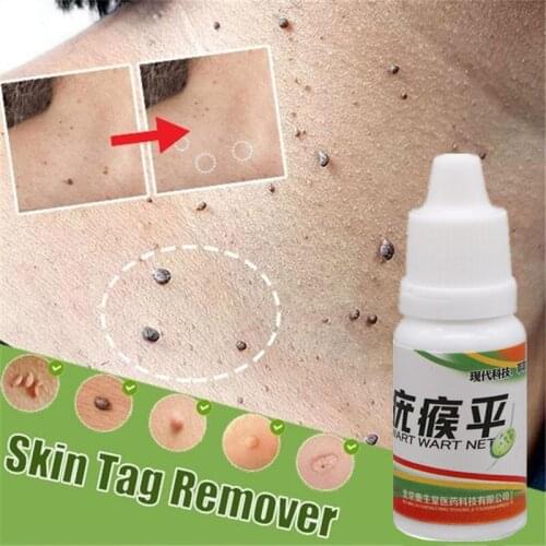 10ml Skin Tag Remover Treatment Foot Corn Removal Mole & Genital Plantar Warts Quick Remove Foot Care Medical Plaster Ointment