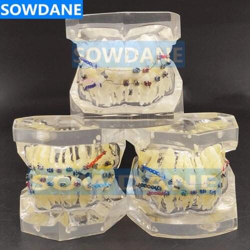 Transparent Dental Orthodontic Mallocclusion Model with Brackets Archwire buccal tube Tooth Extraction for Patient Communication