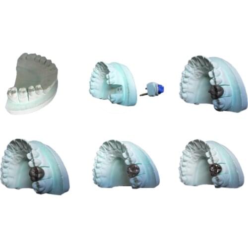 Dental Partially Edentulous Teeth Model Casting Crown Producing Step for Articulator Full Crown Casting Frame Marilan Bridge