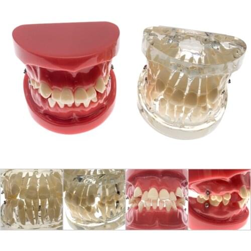 Dental Oral Care Teeth Model Dentist Orthodontic Tooth Model Demonstration Teaching Doctor-Patient Communication Model