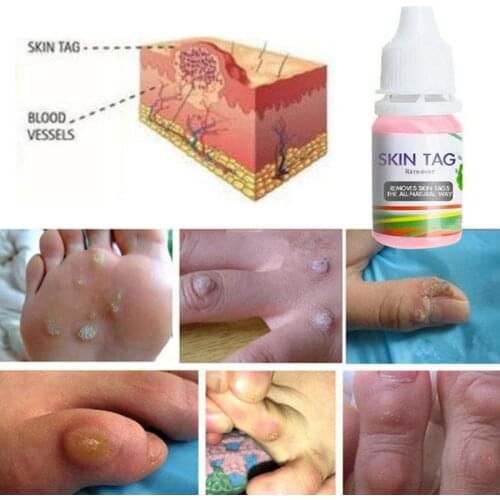 Y98B 10ml Skin Tag Remover Liquid Foot Corn Plantar Body Warts Treatment Ointment