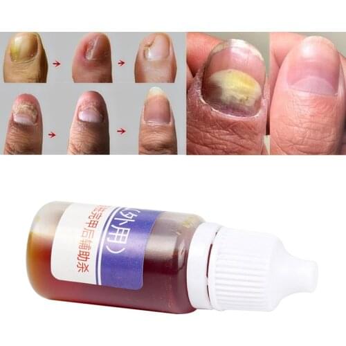 10ml Fungal Nail Treatment Onychomycosis Paronychia Anti Liquid Repair Treatment Onychomycosis Remover Serum TSLM1