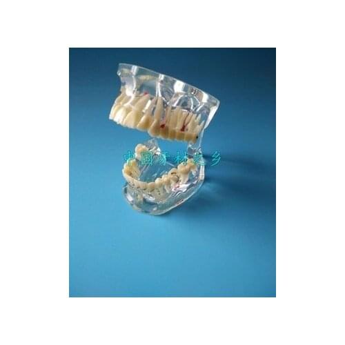 Dental materials Planting nail Case model denture tooth model Doctor-patient communication free shipping