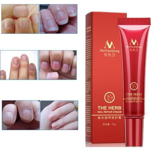 Fungal Nail Feet Care Essence Nail Foot Whitening Toe Nail Fungus Removal Gel Anti Infection Paronychia Onychomycosis Plaster