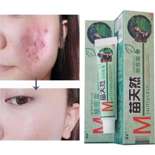 50pcs Fuyou Miaotianran Remove Acne Cream Germicidal Remove Mite and Moisturize Your Skin for Facial Treatment