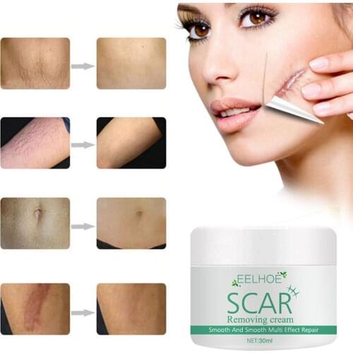 Removal Scar Cream Face Pimples Scar Stretch Marks Removal Acne Treatment Whitening Moisturizing Cream Repair Skin Care Creams