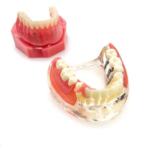 Dental Implant Restoration Teeth Model Removable Bridge Denture Teaching research model for dentistry students