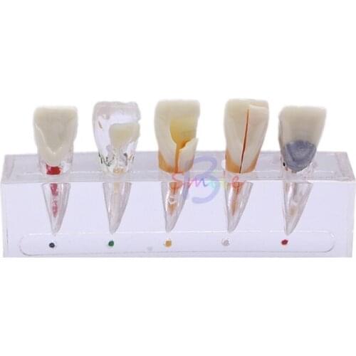 Dental model Endodontic Pathological Model Dental Pulp Restoration Posterior Teeth