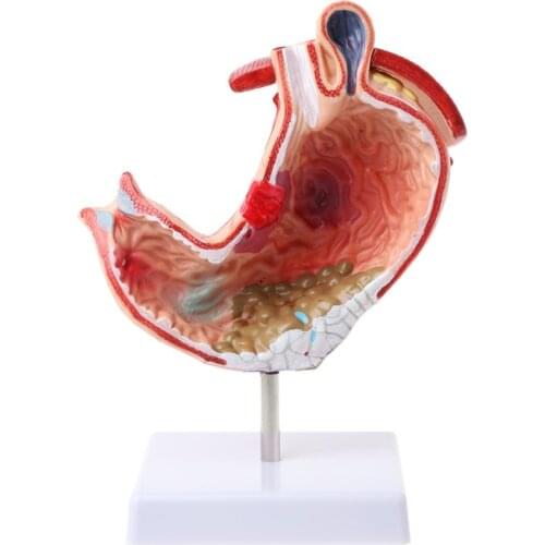 Human Anatomical Anatomy Stomach Model Gastric Pathology Gastritis Ulcer Teaching Learning Tool U4LD