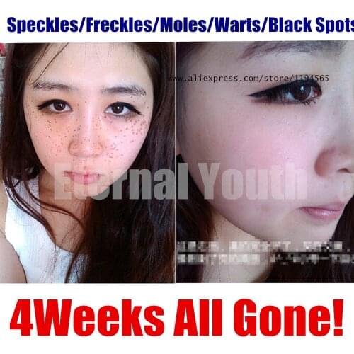 Speckles Moles Warts Removal Black Spots Splashes Remover Free Shipping