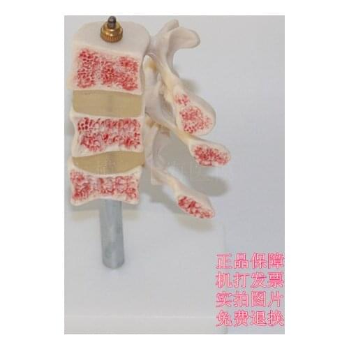 Lesion spinal model Spine model Intervertebral disc model