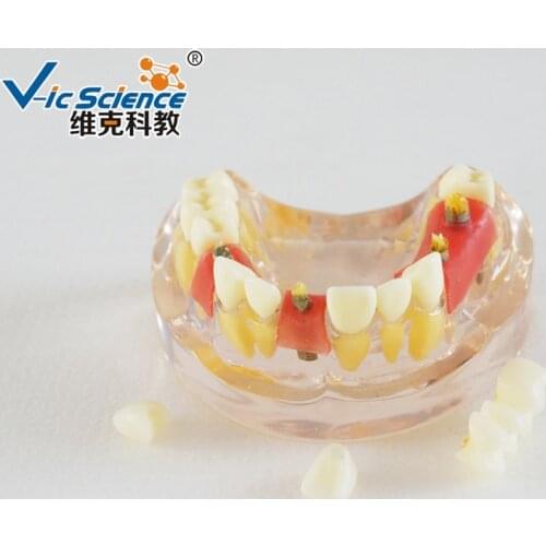 Implant Demonstration Model/Implant Demonstration/Implant Model
