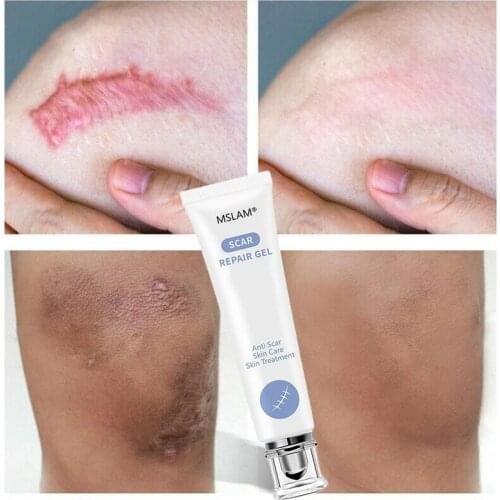 20g Scar Repair Gel Removal Scar Acne Cream Treatment Marks For Face Body Pigmentation Corrector Skin Scar Removal Cream