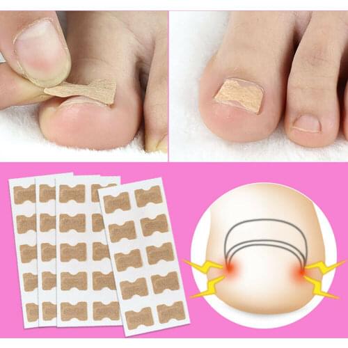 Ingrown Toenail Corrector Sticker Paronychia Treatment Fixer Recover Corrector Pedicure Foot Toe Nail Care Tool Elastic Patch