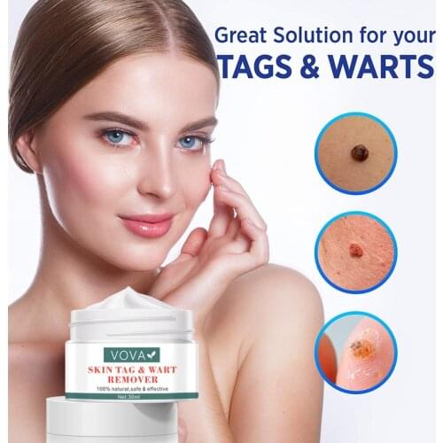 OVA Skin Wart Removal Cream Medical Against Moles Wart Acne Spot Treatment Anti Foot Corn Skin Care Creams Fast Removal Moles1pc