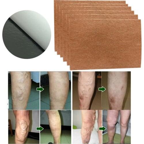 9 Pcs Spider Veins Varicose Treatment Plaster Varicose Veins Cure Patch Vasculitis Natural Solution Herbal Patches